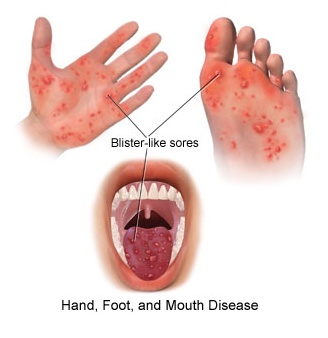 chăm sóc trẻ bị tay chân miệng đúng cách 5